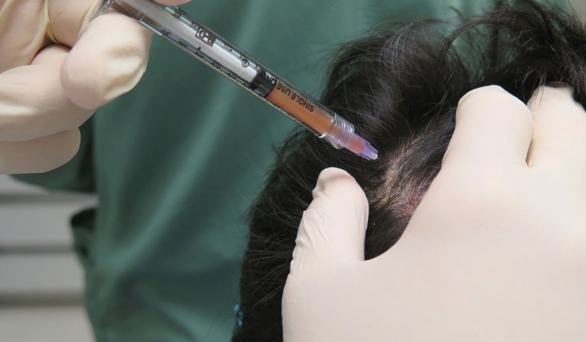 زراعة الشعر في السويد