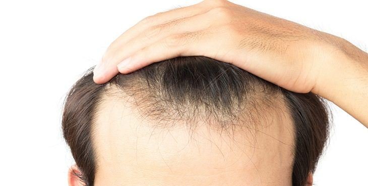 زراعة الشعر في السويد